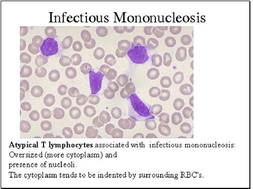 Tabella diagnostica mononucleosi