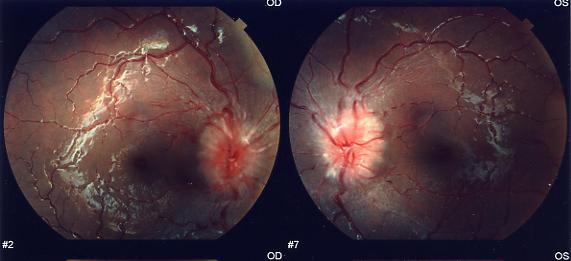 Fondo dell'occhio con papilledema bilaterale