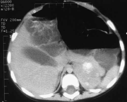 Immagine alla TC con mezzo di contrasto