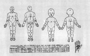 Figura 1 - Mappe per la valutazione dell&rsquo;estensione dell&rsquo;ustione nel bambino