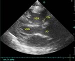 Ecocardiografia: DIV sotto-aortico