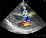 Ecocardiografia color-doppler
