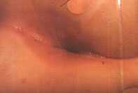 Anite streptococcica